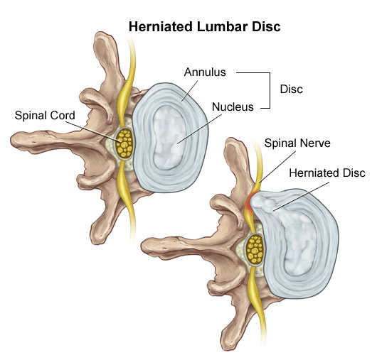 Herniated Lumbar Disc